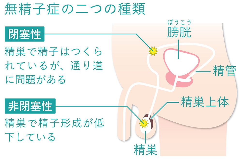 無精子症の二つの種類